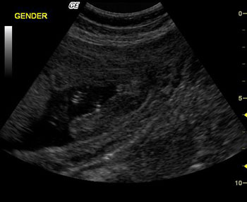 baby gender ultrasound